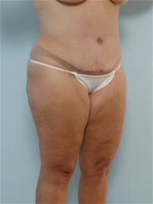 Tummy Tuck After Photo by Paul Vitenas, Jr., MD; Houston, TX - Case 26003