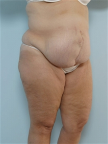 Tummy Tuck Before Photo by Paul Vitenas, Jr., MD; Houston, TX - Case 26003