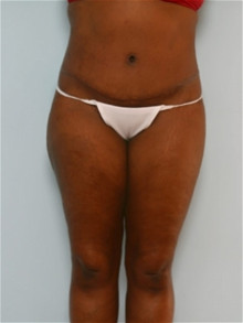 Tummy Tuck After Photo by Paul Vitenas, Jr., MD; Houston, TX - Case 26004