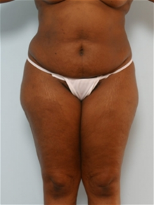 Tummy Tuck Before Photo by Paul Vitenas, Jr., MD; Houston, TX - Case 26004