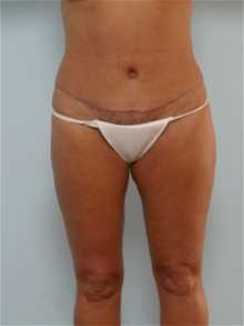 Tummy Tuck After Photo by Paul Vitenas, Jr., MD; Houston, TX - Case 26005