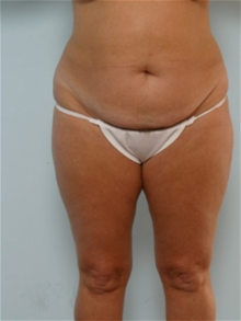 Tummy Tuck Before Photo by Paul Vitenas, Jr., MD; Houston, TX - Case 26005