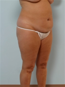 Tummy Tuck Before Photo by Paul Vitenas, Jr., MD; Houston, TX - Case 26005