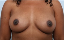 Breast Augmentation After Photo by Paul Vitenas, Jr., MD; Houston, TX - Case 33077