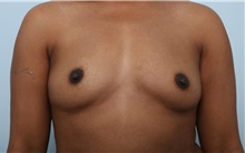 Breast Augmentation Before Photo by Paul Vitenas, Jr., MD; Houston, TX - Case 33077