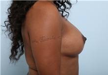 Breast Augmentation After Photo by Paul Vitenas, Jr., MD; Houston, TX - Case 33077
