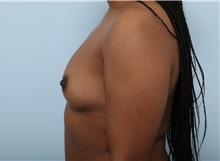 Breast Augmentation Before Photo by Paul Vitenas, Jr., MD; Houston, TX - Case 33077