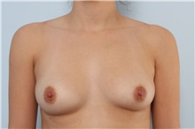 Breast Augmentation Before Photo by Paul Vitenas, Jr., MD; Houston, TX - Case 33079