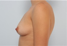Breast Augmentation Before Photo by Paul Vitenas, Jr., MD; Houston, TX - Case 33079