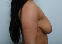 Breast Lift Before Photo by Paul Vitenas, Jr., MD; Houston, TX - Case 36936