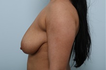 Breast Lift Before Photo by Paul Vitenas, Jr., MD; Houston, TX - Case 36936