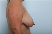 Breast Lift Before Photo by Paul Vitenas, Jr., MD; Houston, TX - Case 36939