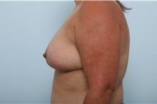 Breast Lift After Photo by Paul Vitenas, Jr., MD; Houston, TX - Case 36939