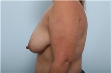 Breast Lift Before Photo by Paul Vitenas, Jr., MD; Houston, TX - Case 36939
