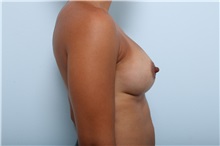 Breast Augmentation After Photo by Paul Vitenas, Jr., MD; Houston, TX - Case 36940