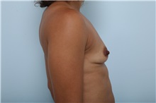 Breast Augmentation Before Photo by Paul Vitenas, Jr., MD; Houston, TX - Case 36940