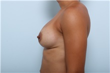 Breast Augmentation After Photo by Paul Vitenas, Jr., MD; Houston, TX - Case 36940