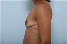 Breast Augmentation Before Photo by Paul Vitenas, Jr., MD; Houston, TX - Case 36940
