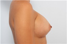 Breast Augmentation After Photo by Paul Vitenas, Jr., MD; Houston, TX - Case 36941