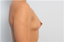 Breast Augmentation Before Photo by Paul Vitenas, Jr., MD; Houston, TX - Case 36941
