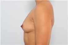 Breast Augmentation Before Photo by Paul Vitenas, Jr., MD; Houston, TX - Case 36941