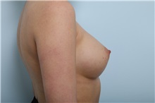 Breast Augmentation After Photo by Paul Vitenas, Jr., MD; Houston, TX - Case 36943