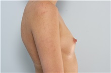 Breast Augmentation Before Photo by Paul Vitenas, Jr., MD; Houston, TX - Case 36943