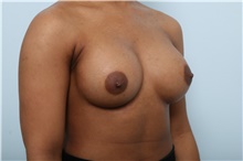 Breast Augmentation After Photo by Paul Vitenas, Jr., MD; Houston, TX - Case 43108