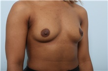 Breast Augmentation Before Photo by Paul Vitenas, Jr., MD; Houston, TX - Case 43108