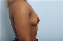Breast Augmentation Before Photo by Paul Vitenas, Jr., MD; Houston, TX - Case 43108