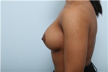 Breast Augmentation After Photo by Paul Vitenas, Jr., MD; Houston, TX - Case 43108