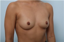 Breast Augmentation Before Photo by Paul Vitenas, Jr., MD; Houston, TX - Case 43109