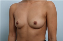 Breast Augmentation Before Photo by Paul Vitenas, Jr., MD; Houston, TX - Case 43109