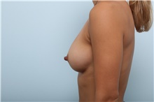 Breast Augmentation After Photo by Paul Vitenas, Jr., MD; Houston, TX - Case 43109