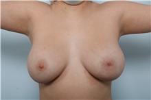 Breast Implant Revision After Photo by Paul Vitenas, Jr., MD; Houston, TX - Case 43586