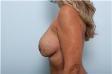 Breast Implant Revision After Photo by Paul Vitenas, Jr., MD; Houston, TX - Case 44891