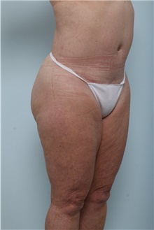 Body Contouring After Photo by Paul Vitenas, Jr., MD; Houston, TX - Case 44899