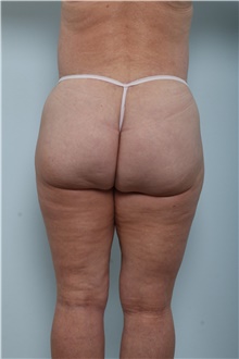 Body Contouring After Photo by Paul Vitenas, Jr., MD; Houston, TX - Case 44899