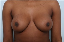 Breast Augmentation After Photo by Paul Vitenas, Jr., MD; Houston, TX - Case 44900