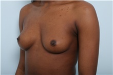 Breast Augmentation Before Photo by Paul Vitenas, Jr., MD; Houston, TX - Case 44900