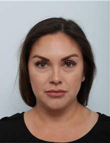 Liposuction Before Photo by Paul Vitenas, Jr., MD; Houston, TX - Case 50002