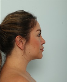 Liposuction After Photo by Paul Vitenas, Jr., MD; Houston, TX - Case 50002