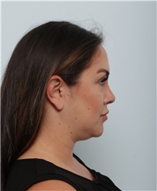 Liposuction Before Photo by Paul Vitenas, Jr., MD; Houston, TX - Case 50002