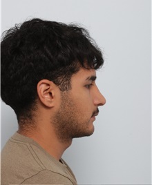 Rhinoplasty After Photo by Paul Vitenas, Jr., MD; Houston, TX - Case 50006