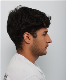Rhinoplasty Before Photo by Paul Vitenas, Jr., MD; Houston, TX - Case 50006