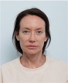 Facelift After Photo by Paul Vitenas, Jr., MD; Houston, TX - Case 50009