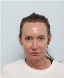 Facelift Before Photo by Paul Vitenas, Jr., MD; Houston, TX - Case 50009