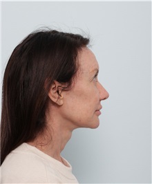 Facelift After Photo by Paul Vitenas, Jr., MD; Houston, TX - Case 50009