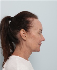 Facelift Before Photo by Paul Vitenas, Jr., MD; Houston, TX - Case 50009