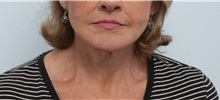 Neck Lift After Photo by Paul Vitenas, Jr., MD; Houston, TX - Case 50003
